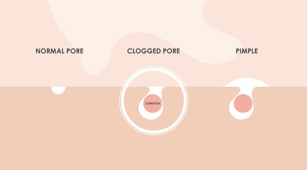 What Causes Clogged Pores & How to Clear Them