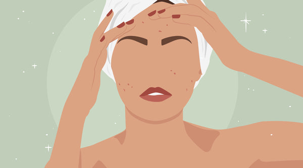 Types of Acne: Pimples & Blackheads Explained